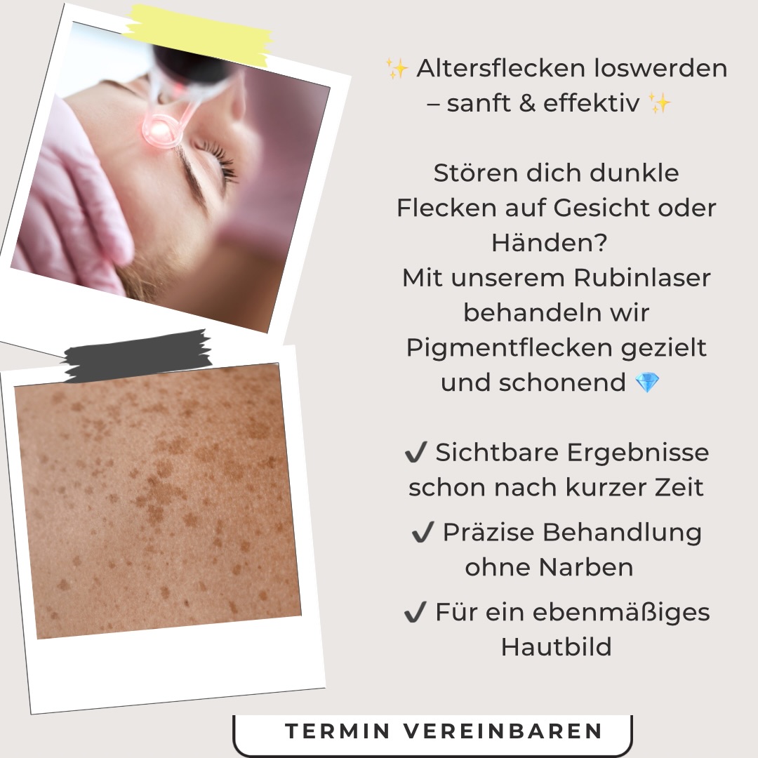 ✨ Altersflecken loswerden – sanft & effektiv ✨#Laserbehandlung #Altersflecken #Pigmentflecken #Sommersprossen #Dermatologie