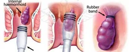 Andere minimalinvasive Methoden